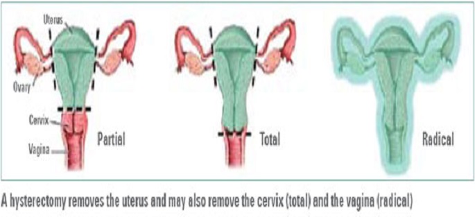 Hysterectomy Discharge Instructions